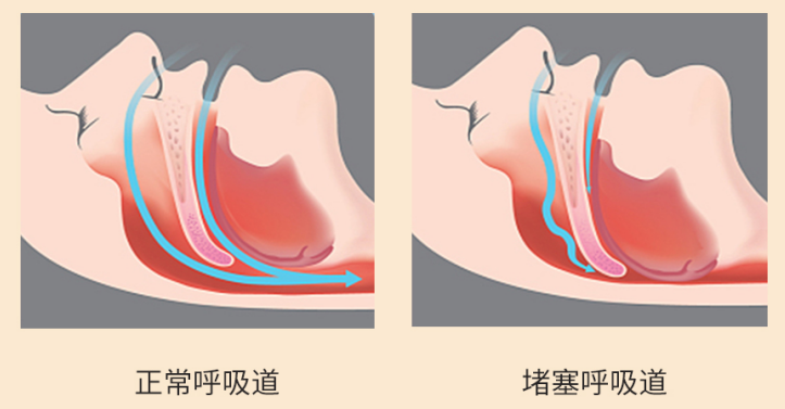 什么是睡眠呼吸暂停综合征？