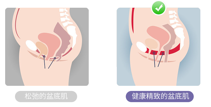 “盆底肌肉高张，容易诱发性交痛”