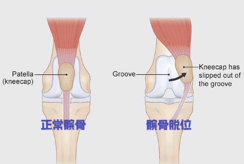 电磁式冲击波疗法在髌骨脱位术后康复的应用