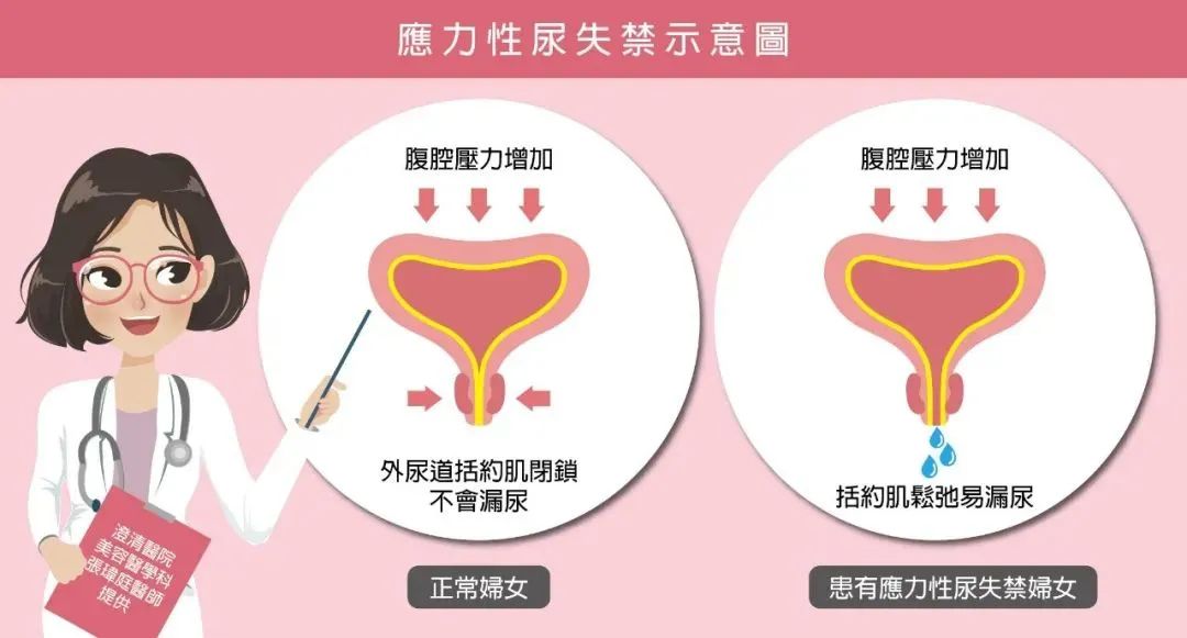 压力性尿失禁