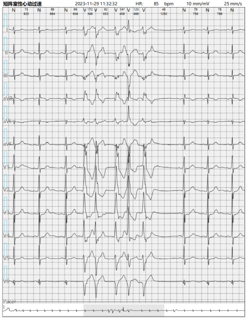 短阵室性心动过速