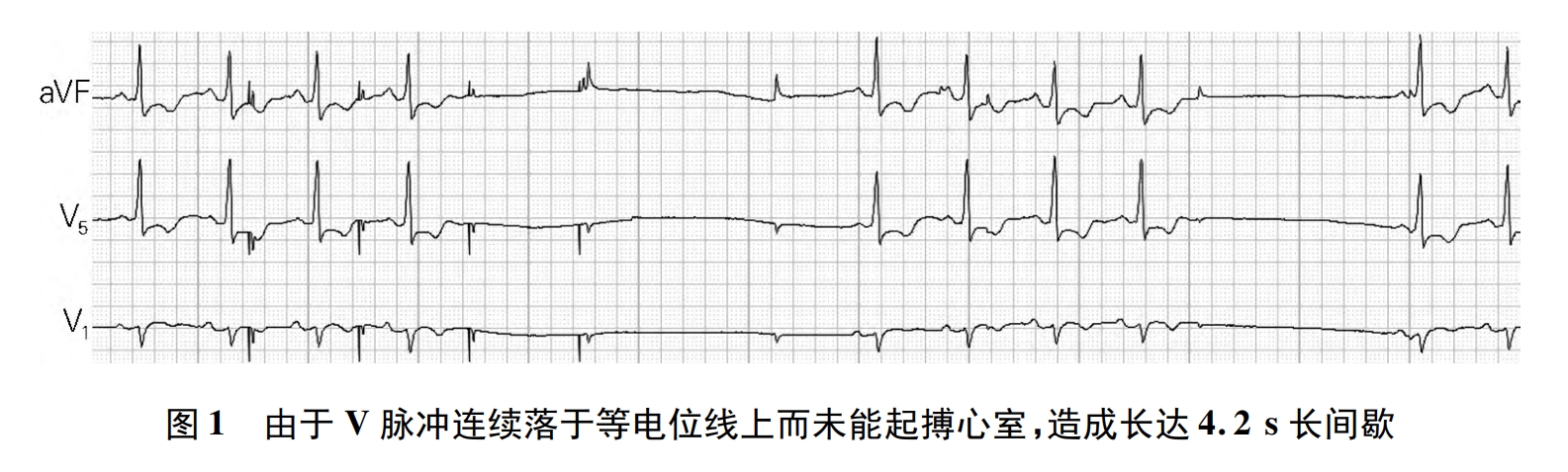 起搏器电极断裂