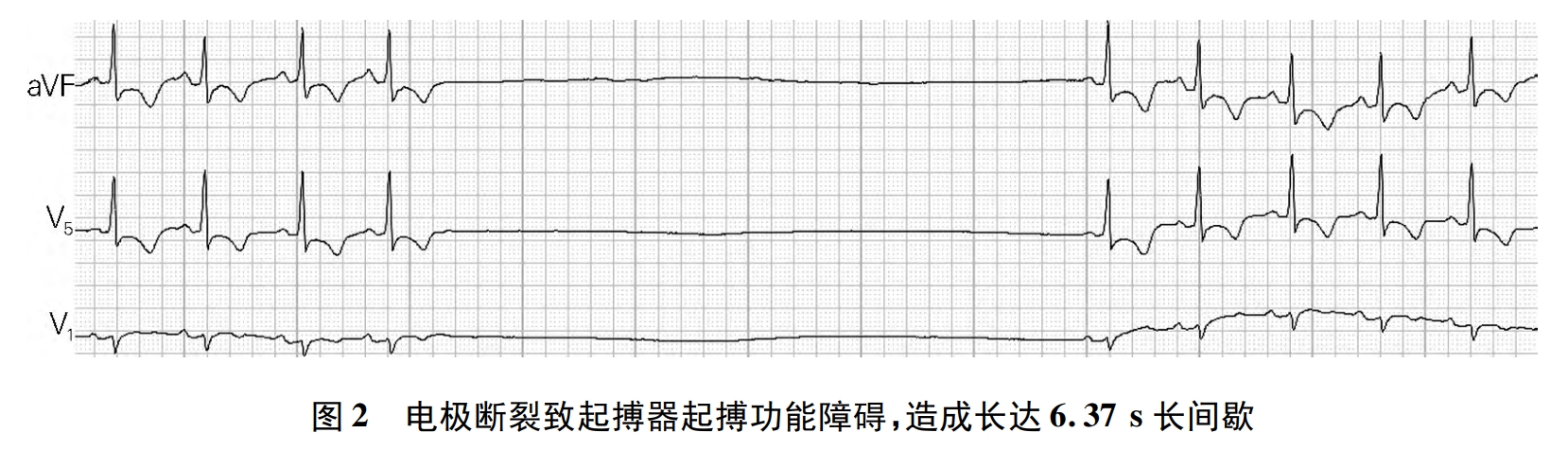 起搏器电极断裂