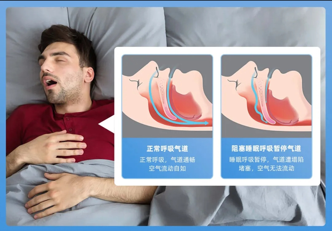 阻塞性睡眠呼吸暂停（OSA）