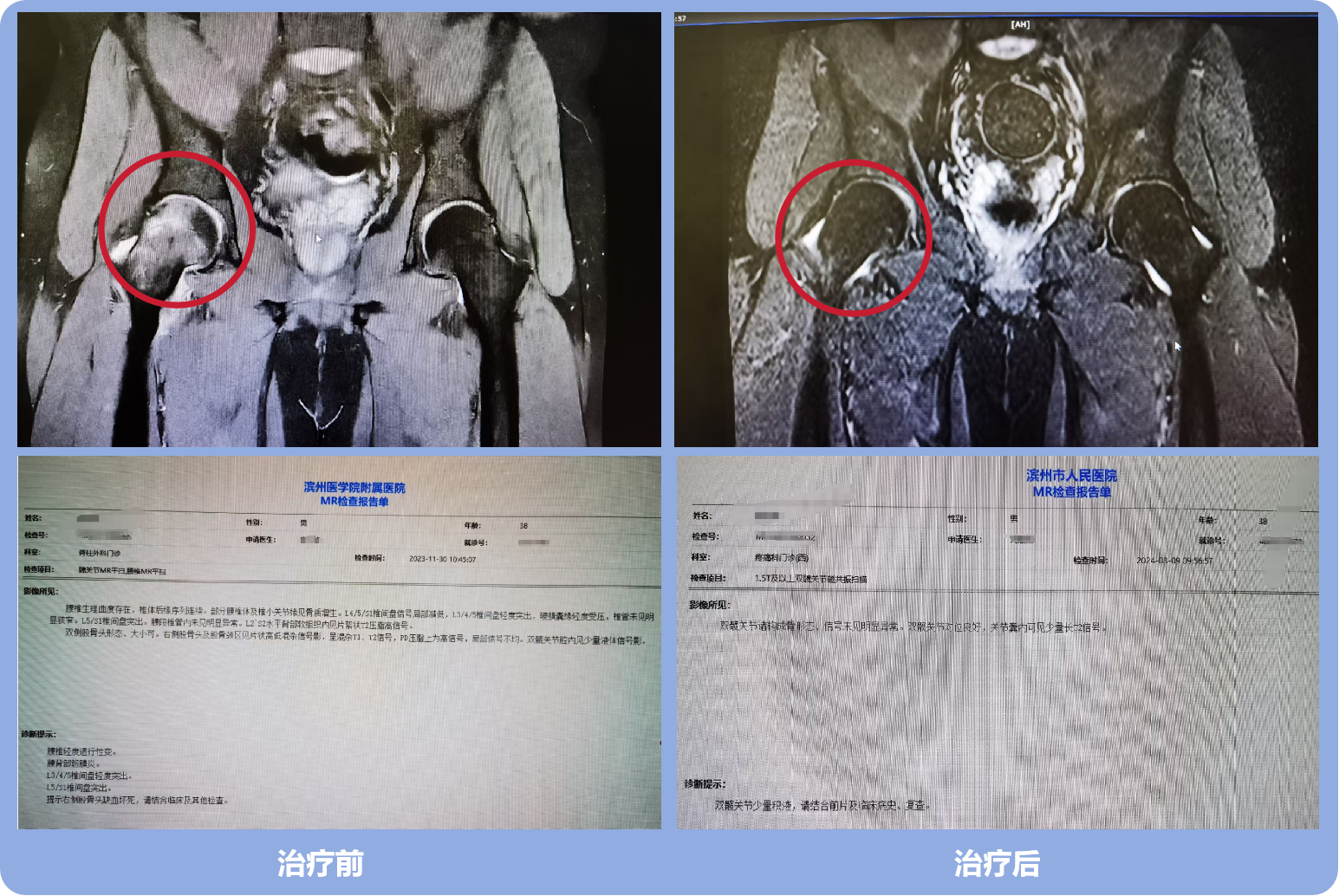 乐普冲击波治好股骨头缺血性坏死，让患者恢复自在生活！